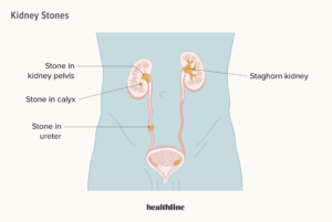 kidney stonekidney stone treatment
kidney stone removal
kidney stone pain
kidney stone surgery
kidney stone ureteroscopic stone removal
kidney stone laser treatment cost
lithotripsy
nephrolithiasis