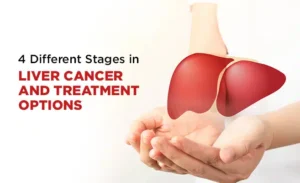 liver cancerhepatocellular carcinoma best treatment for stage 4 liver cancer liver tumor treatment types of liver cancer stage 4 metastatic liver cancer life expectancy stage 4 liver cancer what to expect stage 4 liver cancer liver cancer prognosis best liver cancer treatment in world