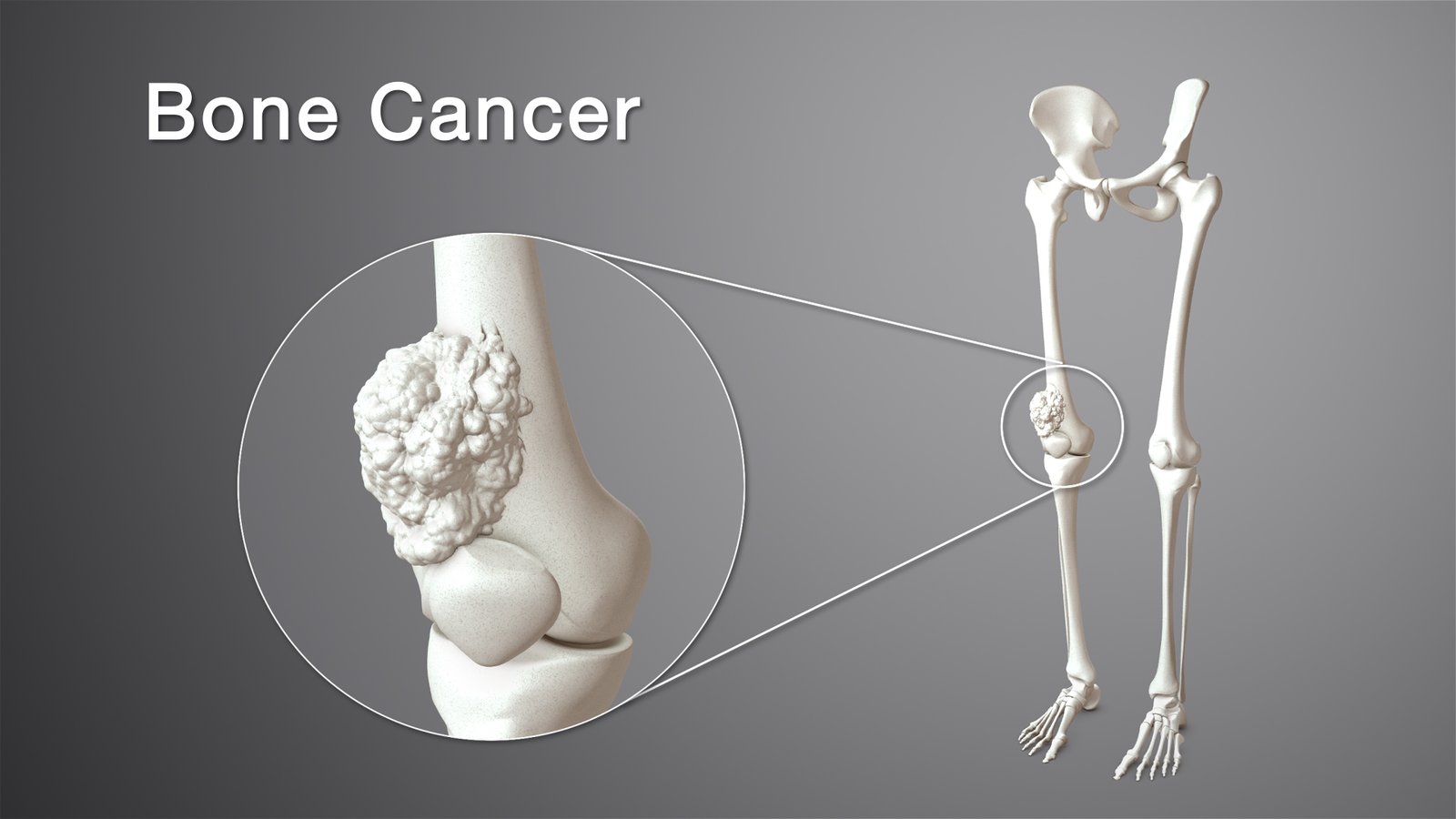 sarcoma cancer sarcoma ewing sarcoma synovial sarcoma bone cancer symptoms bone cancer bone cancer treatment sarcoma symptoms symptoms of metastatic breast cancer in bones