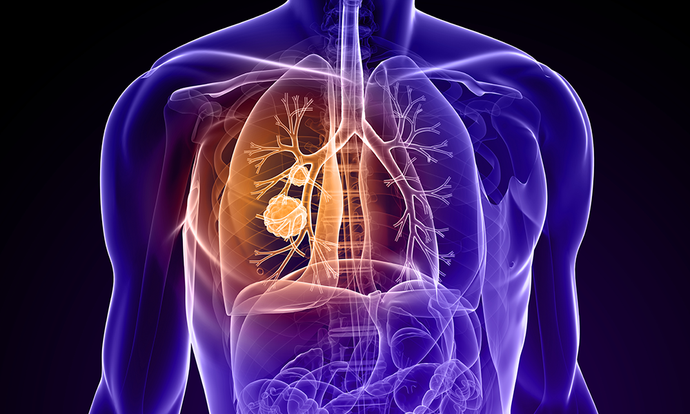 lungs cancer lung cancer symptoms signs of lung cancer lung cancer survival rate lung cancer treatment small cell carcinoma symptoms of lung cancer in females