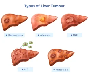 liver cancerhepatocellular carcinoma best treatment for stage 4 liver cancer liver tumor treatment types of liver cancer stage 4 metastatic liver cancer life expectancy stage 4 liver cancer what to expect stage 4 liver cancer liver cancer prognosis best liver cancer treatment in world