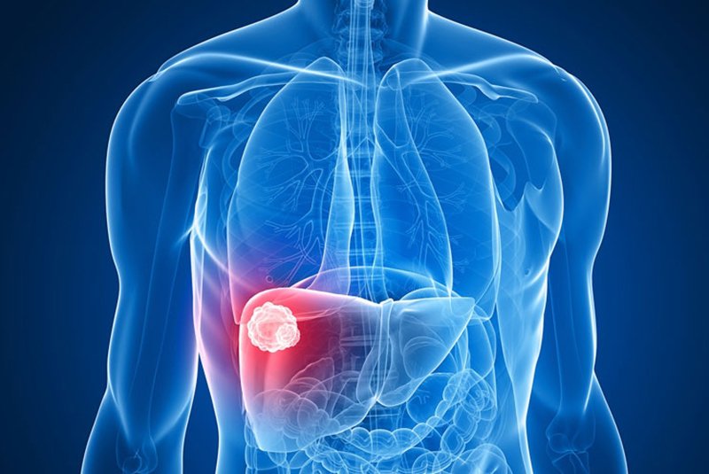 liver cancer hepatocellular carcinoma best treatment for stage 4 liver cancer liver tumor treatment types of liver cancer stage 4 metastatic liver cancer life expectancy stage 4 liver cancer what to expect stage 4 liver cancer liver cancer prognosis best liver cancer treatment in world