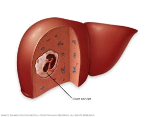 liver cancerhepatocellular carcinoma best treatment for stage 4 liver cancer liver tumor treatment types of liver cancer stage 4 metastatic liver cancer life expectancy stage 4 liver cancer what to expect stage 4 liver cancer liver cancer prognosis best liver cancer treatment in world