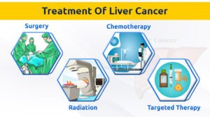 liver cancerhepatocellular carcinoma best treatment for stage 4 liver cancer liver tumor treatment types of liver cancer stage 4 metastatic liver cancer life expectancy stage 4 liver cancer what to expect stage 4 liver cancer liver cancer prognosis best liver cancer treatment in world