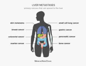 liver cancerhepatocellular carcinoma best treatment for stage 4 liver cancer liver tumor treatment types of liver cancer stage 4 metastatic liver cancer life expectancy stage 4 liver cancer what to expect stage 4 liver cancer liver cancer prognosis best liver cancer treatment in world